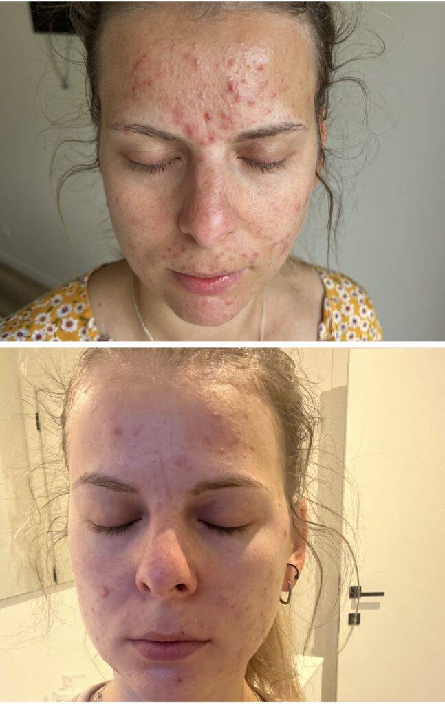Voor en na van een acnebehandeling
